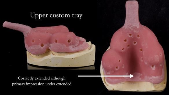 Newsletter 77: Jeremy’s case – immediate complete upper denture