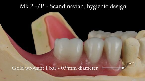 Newsletter 52 Managing Jo’s failing dentition with extractions and Mk 1/Mk 2 complete upper dentures and lower partial dentures FULL PROTOCOL
