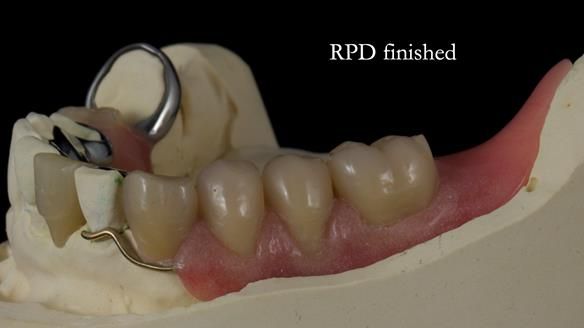 Newsletter 55 Provision of metal based partial dentures for Zephyrine with a repaired cleft lip and palate