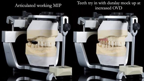 Finlay's Newsletter 64 case study - provision of a Kennedy class 2 metal based Scandinavian RPD for Ian