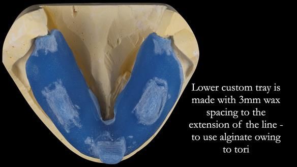 Newsletter 53 showing the making and fitting of ultra life-like dentures for Valena