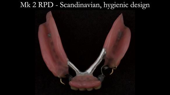 Finlay's Case Study Newsletter 40 - Immediate Mk 1 RPD to Definitive Mk 2 RPD - full protocol