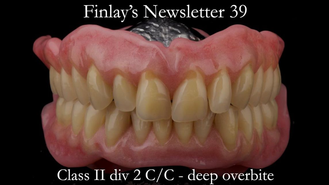 Complete denture Class II div 2 deep overbite Newsletter 39