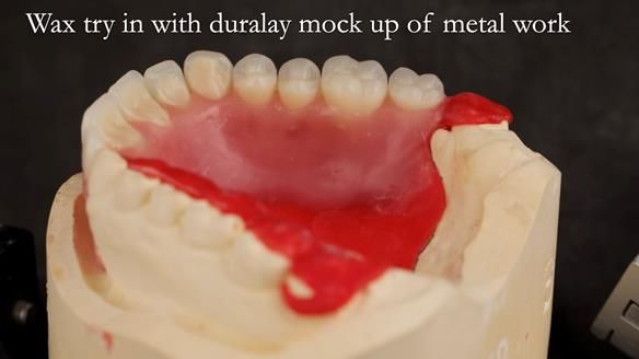 Upper metal base partial denture/occlusal stabilisation splint/obturator - full protocol