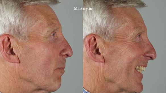 Newsletter 77: Jeremy’s case – immediate complete upper denture