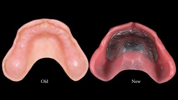 Newsletter 78: What do Clark Gable and a Locator® overdenture have in common?