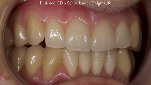 Newsletter 83: Sheila’s Complete Denture Success