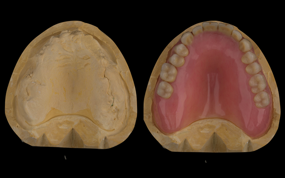 Figure 58 Dental laboratory reline cast without and with denture