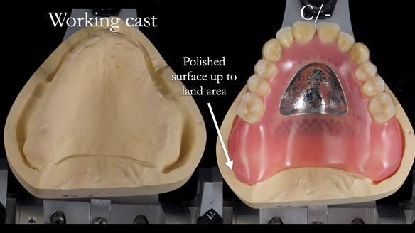 Newsletter 54 case presentation upper complete denture and lower Scandinavian designed hygienic partial denture for David