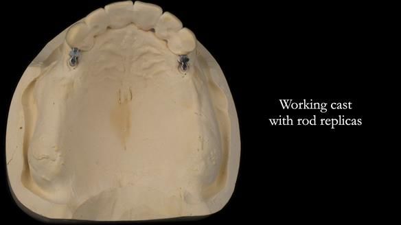 Newsletter 76: Jackie’s case – Telescopic overdenture & precision RPD (the tricky truth!)