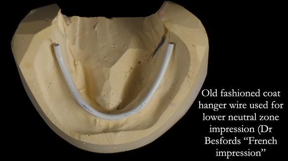 Newsletter 83: Sheila’s Complete Denture Success