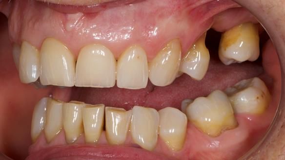 Finlay's Newsletter 61 provision of a lower unilateral free end saddle metal based partial denture for Joyce