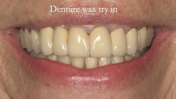 Newsletter 76: Jackie’s case – Telescopic overdenture & precision RPD (the tricky truth!)