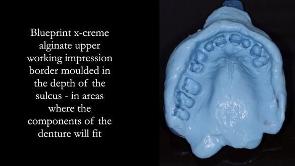 Finlay's Newsletter 64 case study - provision of a Kennedy class 2 metal based Scandinavian RPD for Ian