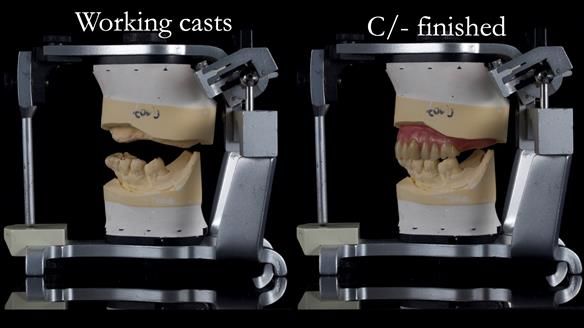Newsletter 54 case presentation upper complete denture and lower Scandinavian designed hygienic partial denture for David