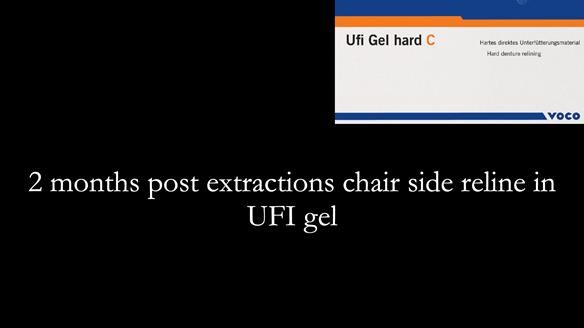 Newsletter 52 Managing Jo’s failing dentition with extractions and Mk 1/Mk 2 complete upper dentures and lower partial dentures FULL PROTOCOL