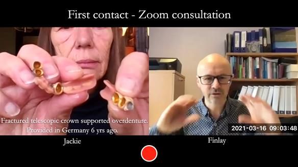 Newsletter 76: Jackie’s case – Telescopic overdenture & precision RPD (the tricky truth!)