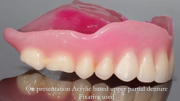 Finlay's Newsletter 58 Gasket upper partial denture for Zoe