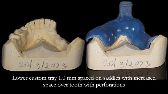 Finlay's Newsletter 61 provision of a lower unilateral free end saddle metal based partial denture for Joyce