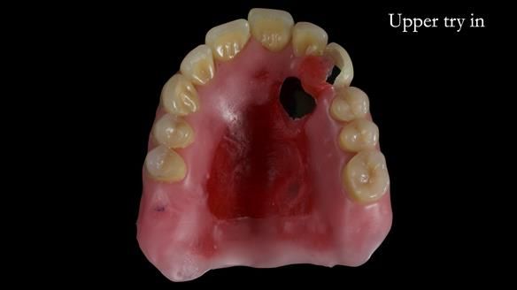 Newsletter 55 Provision of metal based partial dentures for Zephyrine with a repaired cleft lip and palate