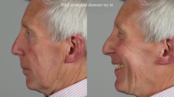 Newsletter 77: Jeremy’s case – immediate complete upper denture