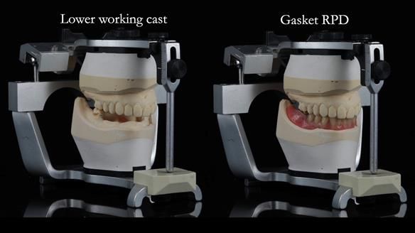 Newsletter 82 Mary - A complete upper and a one-tooth gasket denture