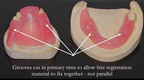 Finlay's Newsletter 59 Ultra hard partial dentures made for Gill