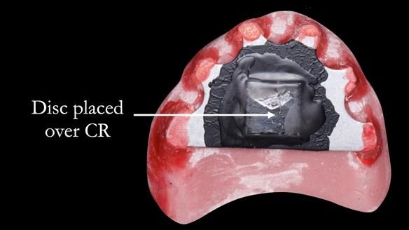 Managing poor implant positioning with complete dentures and Locator attachments - full protocol Newsletter 41