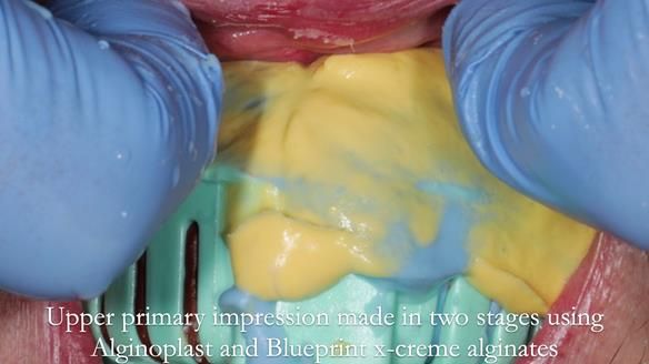 Newsletter 55 Provision of metal based partial dentures for Zephyrine with a repaired cleft lip and palate