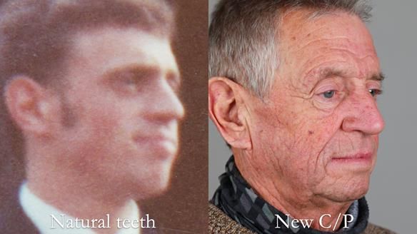 Newsletter 54 case presentation upper complete denture and lower Scandinavian designed hygienic partial denture for David