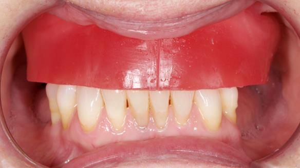 Solving Linda’s Failed “All on 4” implant bridges - full protocol Newsletter 42