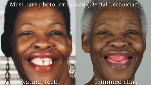 Newsletter 53 showing the making and fitting of ultra life-like dentures for Valena