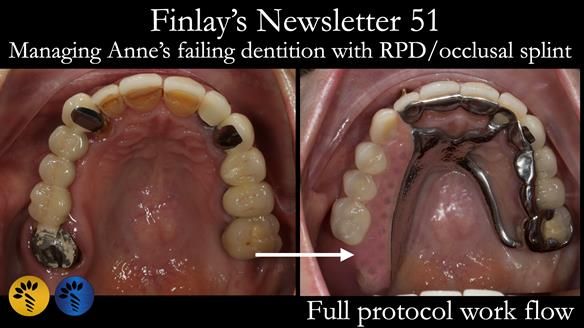 Newsletter 51 Managing Anne’s failing dentition with distal extension base RPD/Splint FULL PROTOCOL