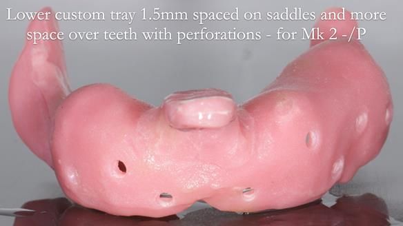 Newsletter 54 case presentation upper complete denture and lower Scandinavian designed hygienic partial denture for David