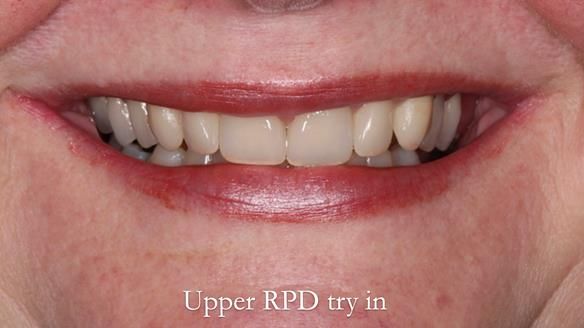 Finlay's Newsletter 58 Gasket upper partial denture for Zoe