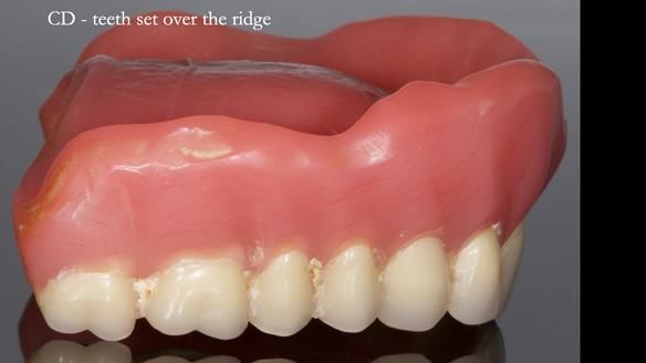 Newsletter 83: Sheila’s Complete Denture Success