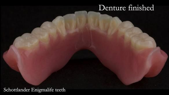Newsletter 75: Marion’s case - Step-by-step complete denture workflow