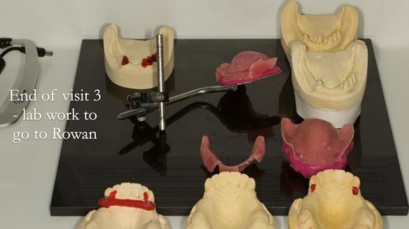 Newsletter 76: Jackie’s case – Telescopic overdenture & precision RPD (the tricky truth!)