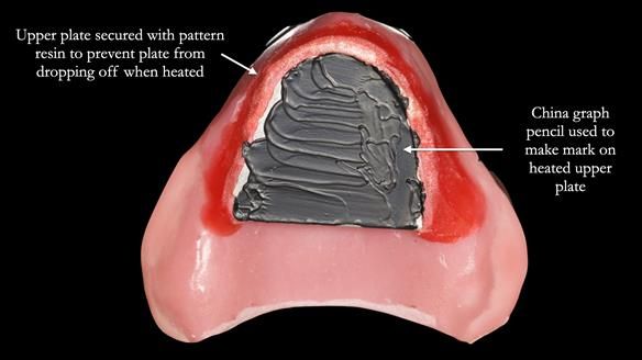 Newsletter 54 case presentation upper complete denture and lower Scandinavian designed hygienic partial denture for David