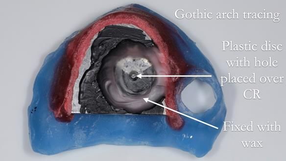 Finlay's Newsletter 58 Gasket upper partial denture for Zoe