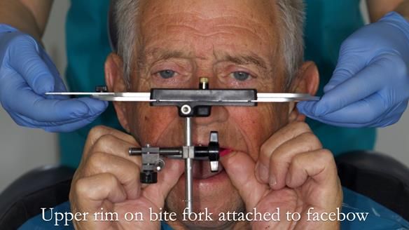 Newsletter 54 case presentation upper complete denture and lower Scandinavian designed hygienic partial denture for David