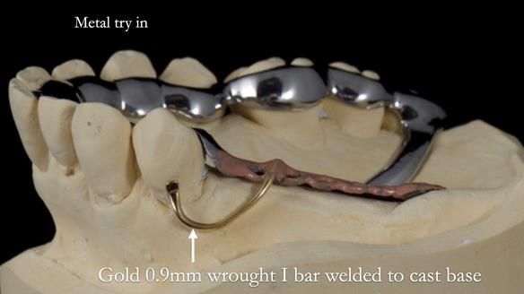 Finlay's Newsletter 64 case study - provision of a Kennedy class 2 metal based Scandinavian RPD for Ian