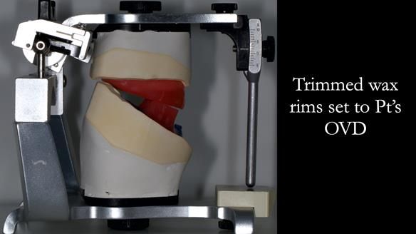 Newsletter 78: What do Clark Gable and a Locator® overdenture have in common?