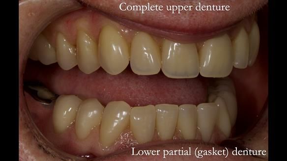 Newsletter 82 Mary - A complete upper and a one-tooth gasket denture