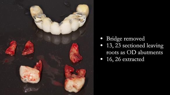 Newsletter 77: Jeremy’s case – immediate complete upper denture