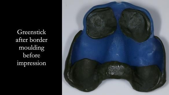 Newsletter 77: Jeremy’s case – immediate complete upper denture