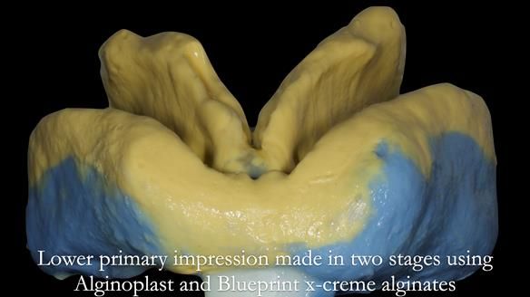 Newsletter 53 showing the making and fitting of ultra life-like dentures for Valena