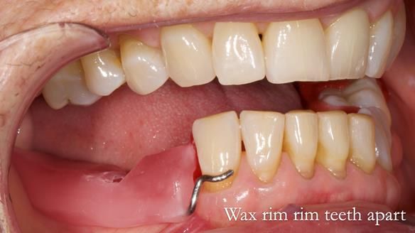 Finlay's Newsletter 61 provision of a lower unilateral free end saddle metal based partial denture for Joyce