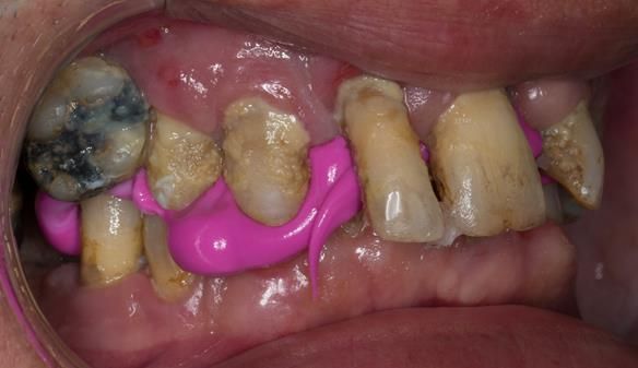 Figure 8 Inter-maxillary registration using Futar D bite registration material in intercuspal position (ICP). The Mk 1 immediate complete denture will conform to ICP. Ideally the immediate complete denture would be fabricated in centric relation (CR)
