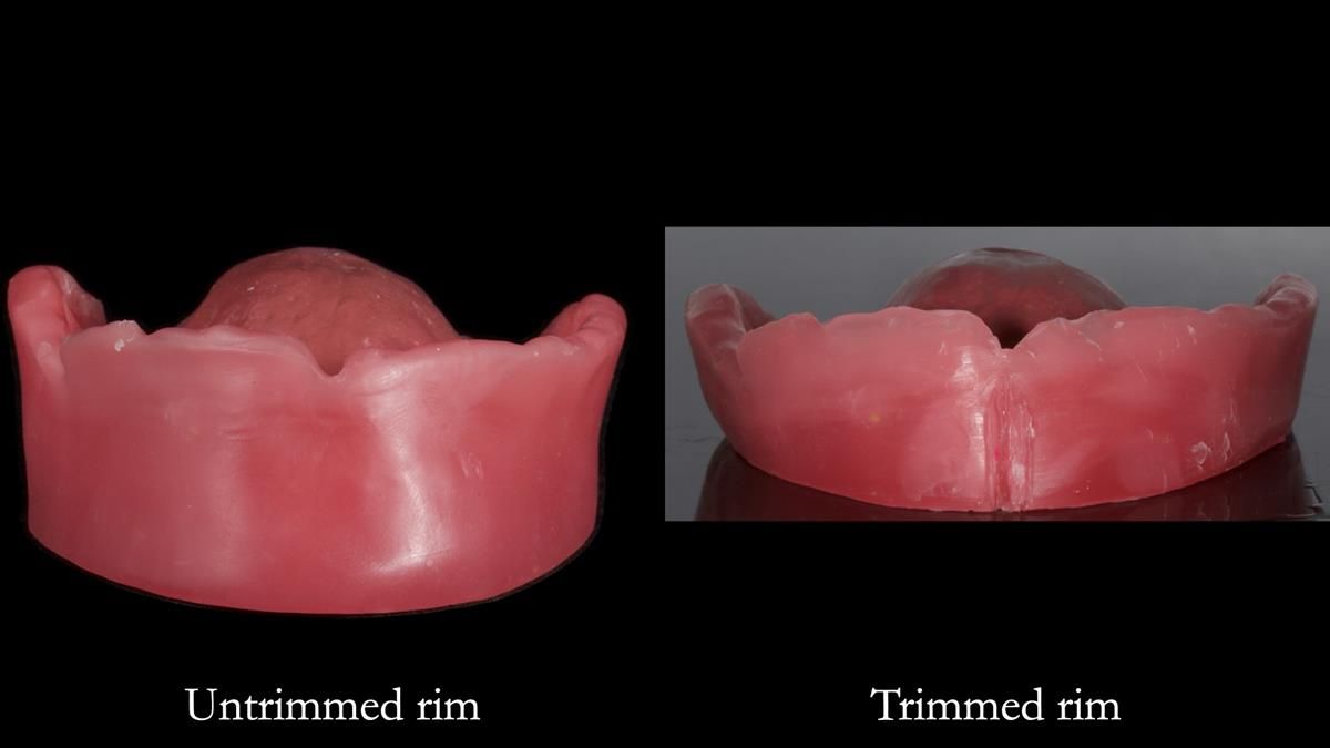 Fin’s Newsletter 88 — Complete dentures - full protocol… he rearranged his own teeth!
